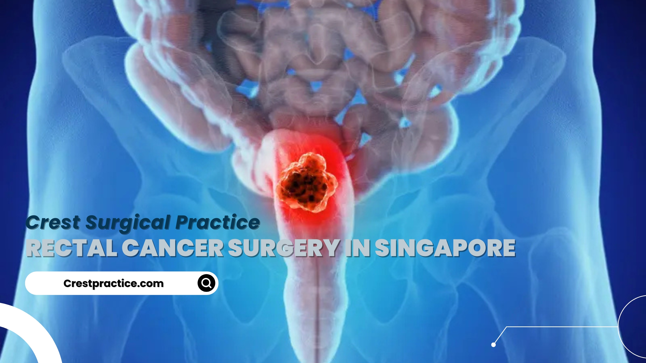 Surgical Solutions for Rectal Cancer