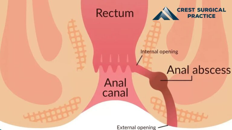 Anal Abscess Surgery in Singapore