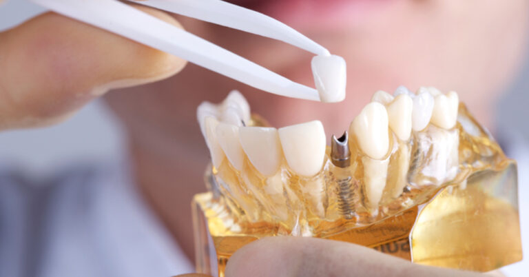Root Canal in Richmond